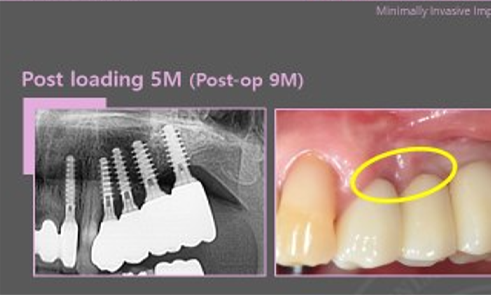 Before implant treatment