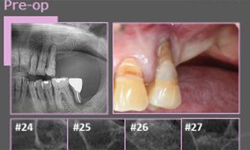 After implant treatment