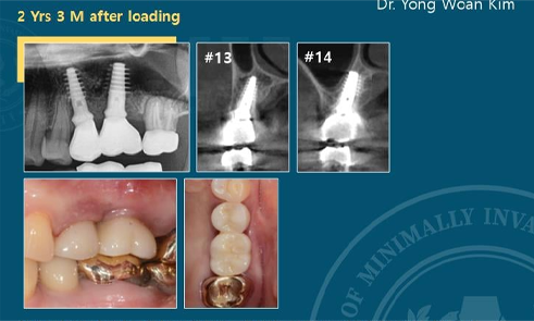Before implant treatment
