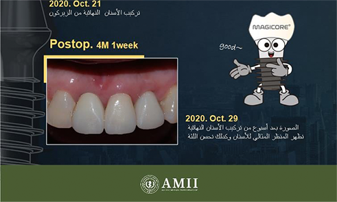 Before implant treatment